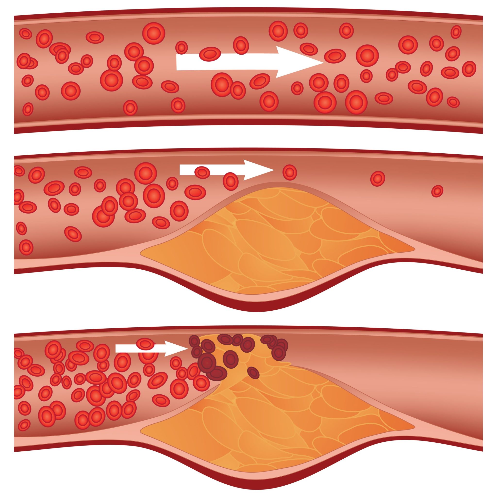 Atherosclerosis - Clogged Arteries